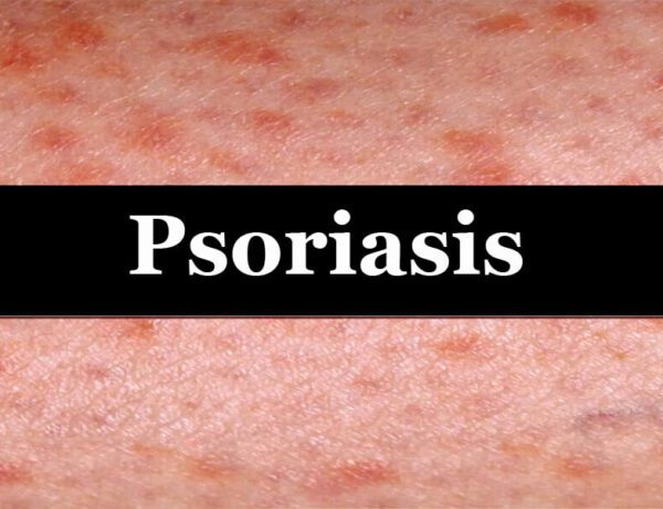 Psoriasis treatment