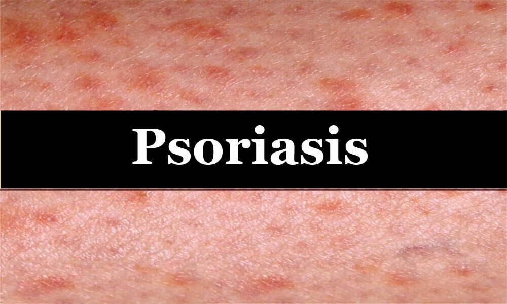 Psoriasis treatment