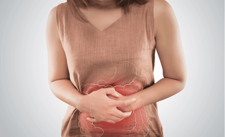Irritable Bowel Syndrome (IBS)