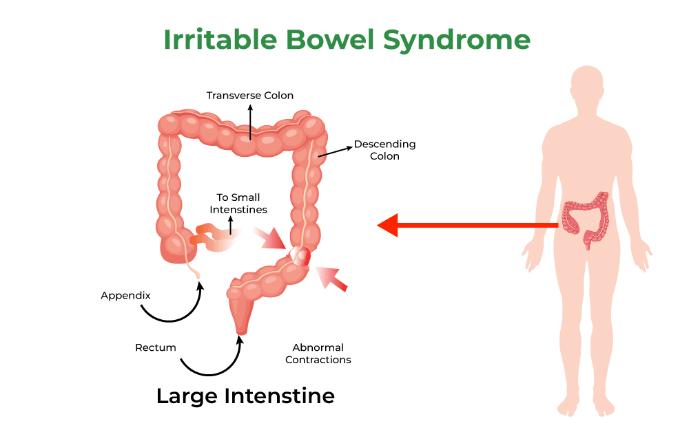 Irritable Bowel Syndrome
