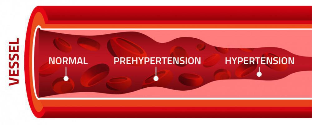 Hypertension symptoms