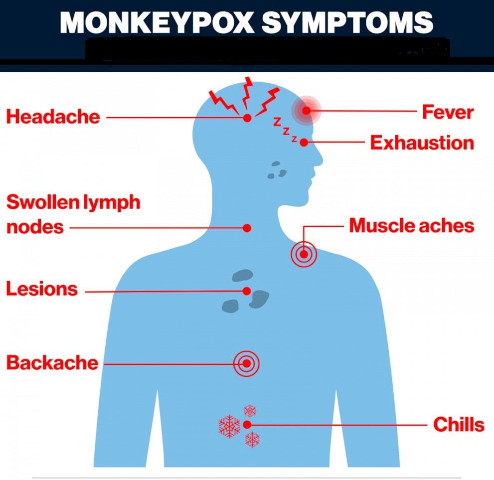 Monkeypox virus