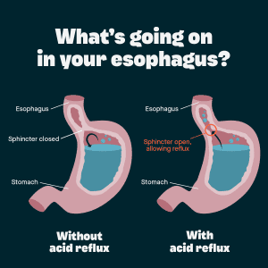 acid reflux causes