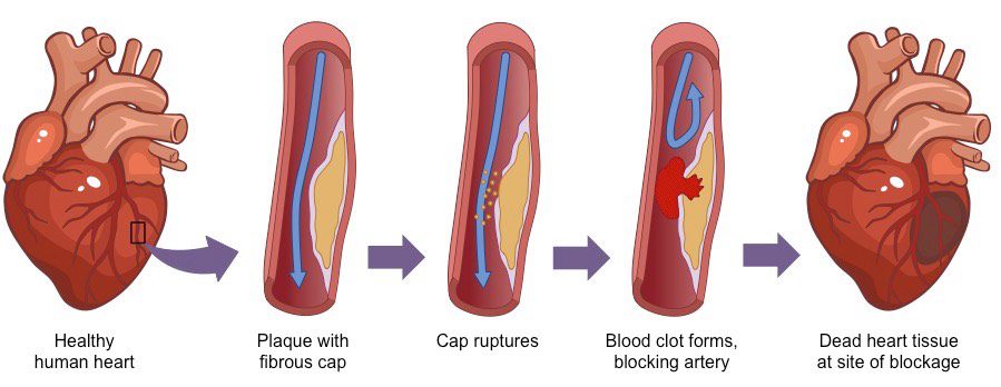 signs of heart attack