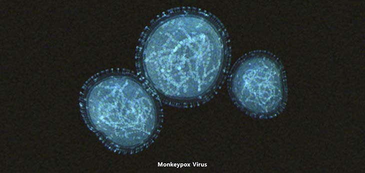 monkeypox virus symptoms