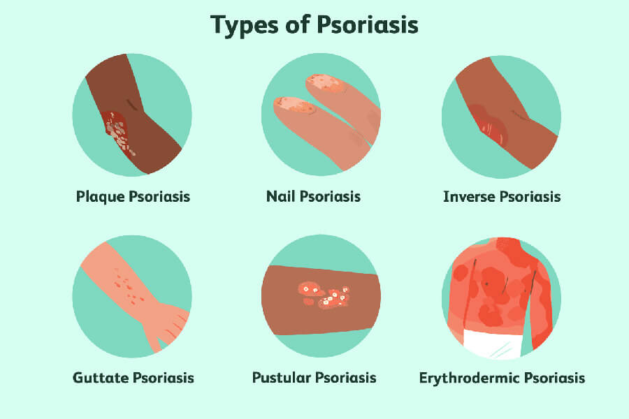 psoriasis symptoms